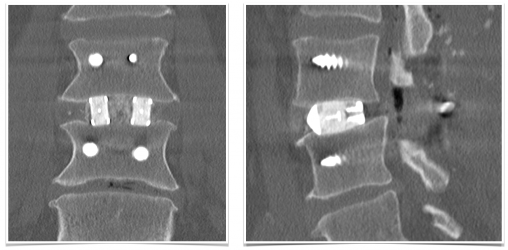 Postoperative CT scan of PLIF demonstrating screws, cages, decompression, bone graft